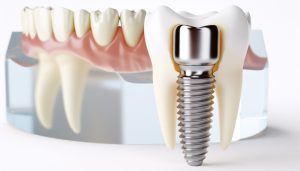 Does Aetna Medicare Cover Dental Implants?, Understanding Aetna's Dental Benefits